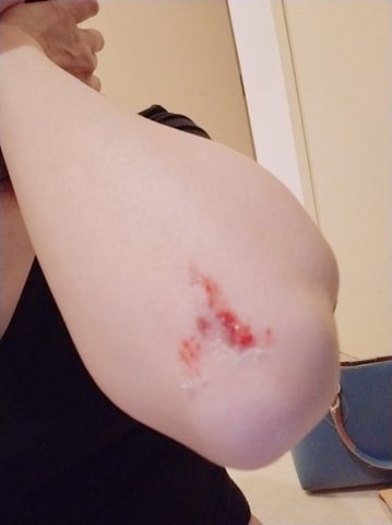 酔っぱらって怪我しました