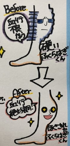 ふくらはぎのその後