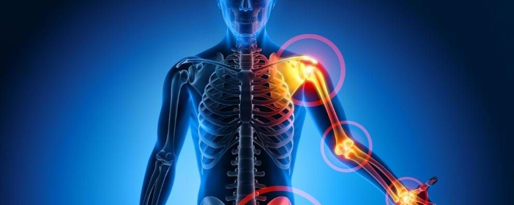 Human skeleton with highlighted pain points in shoulder, elbow, wrist, and hip joints