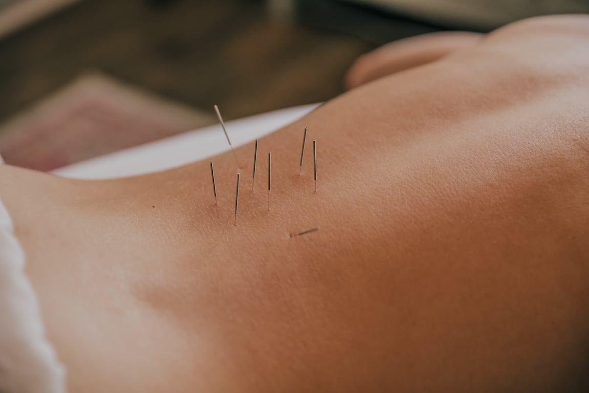 Acupuncturist attaching electroacupuncture clips to needles during a chronic pain treatment in Marble Falls, TX