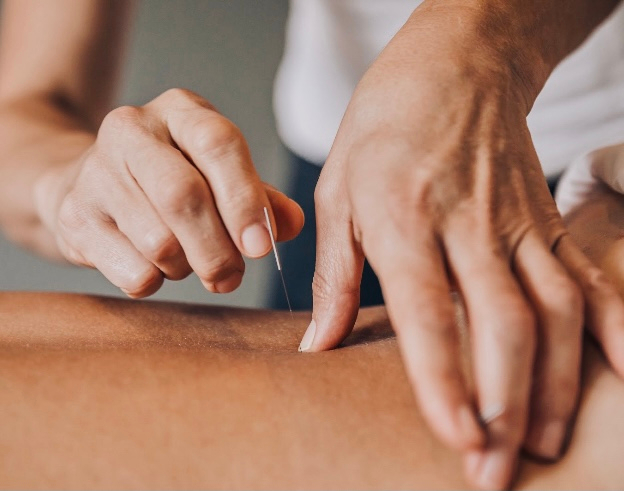 Acupuncture needles placed during treatment at Palomino Massage & Acupuncture