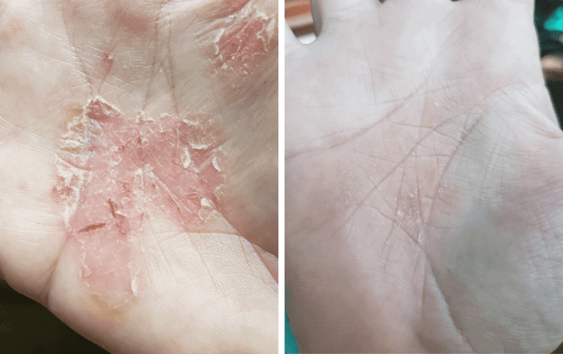 a close up of a hand with a rash