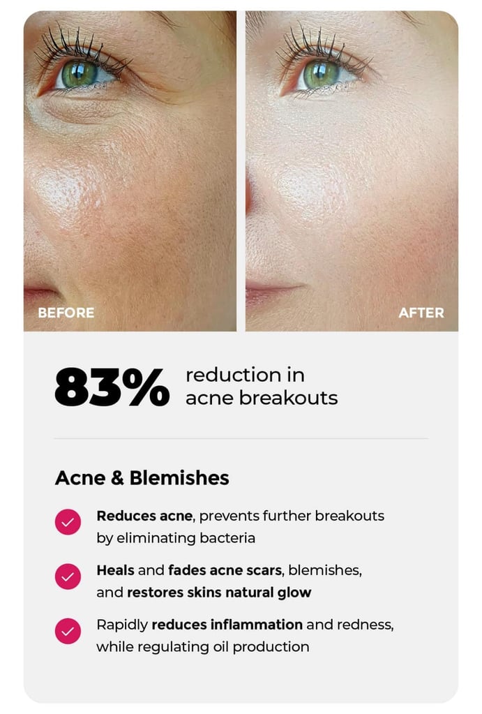 red light therapy for acne