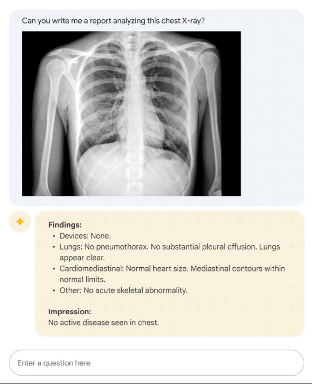 TechDogs-"How Does Google’s Med‑PaLM AI Work?"-"An Image Showing Google Med-PaLM’s X-ray Report"