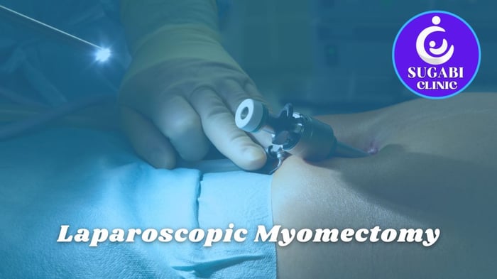 Laparoscopic Myomectomy: Removing Fibroids, Keeping Your Womb
