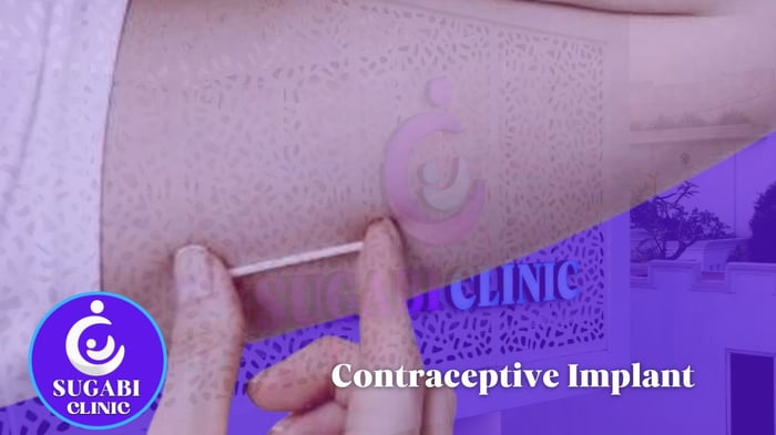 The Contraceptive Implant (Jadelle): 5 Years of Protection
