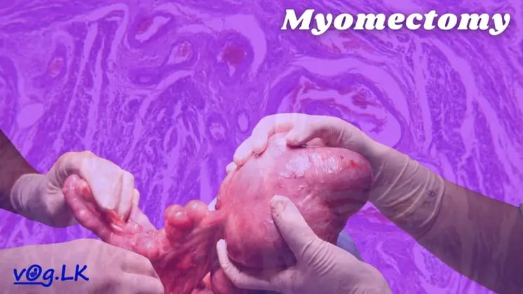 Myomectomy 
