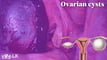ඩිම්බ කෝෂ වල ගෙඩි ගැන දැන ගන්න