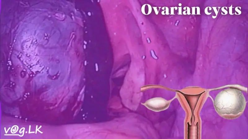 ඩිම්බ කෝෂ වල ගෙඩි ගැන දැන ගන්න