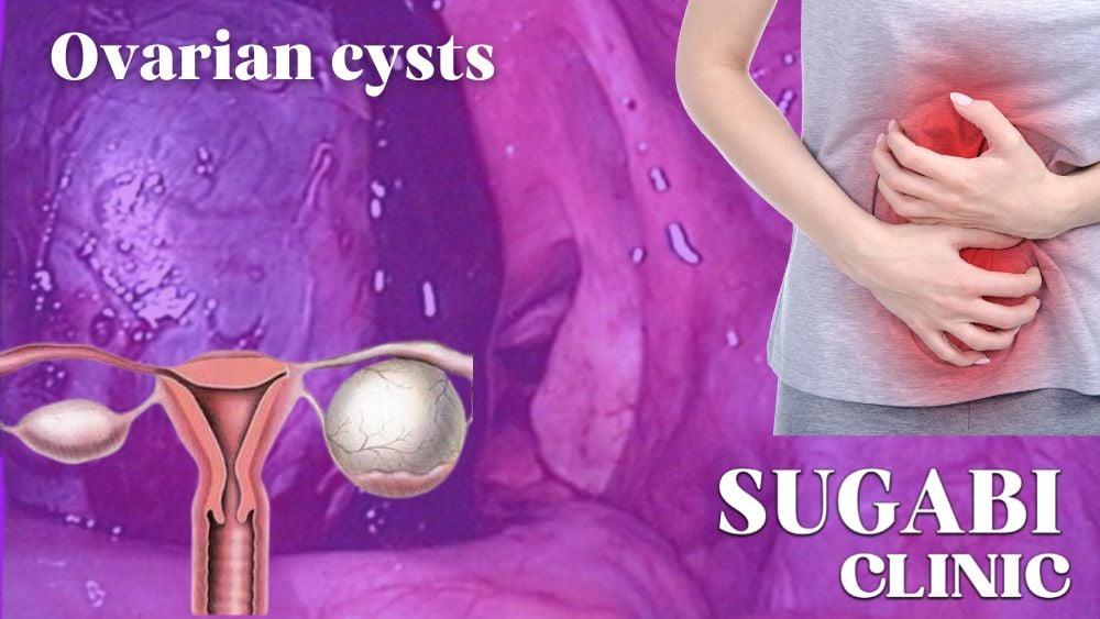 Ovarian Cysts Symptoms, Treatment & Prevention Sugabi Clinic