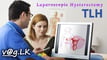total-laparoscopic-hysterectomy