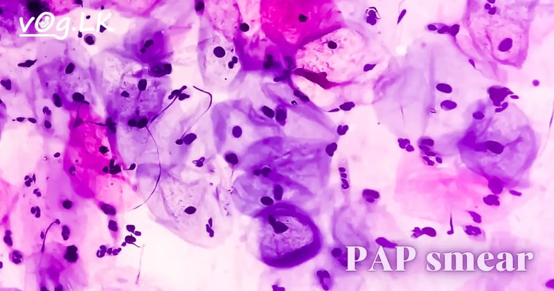 PAP Smear test