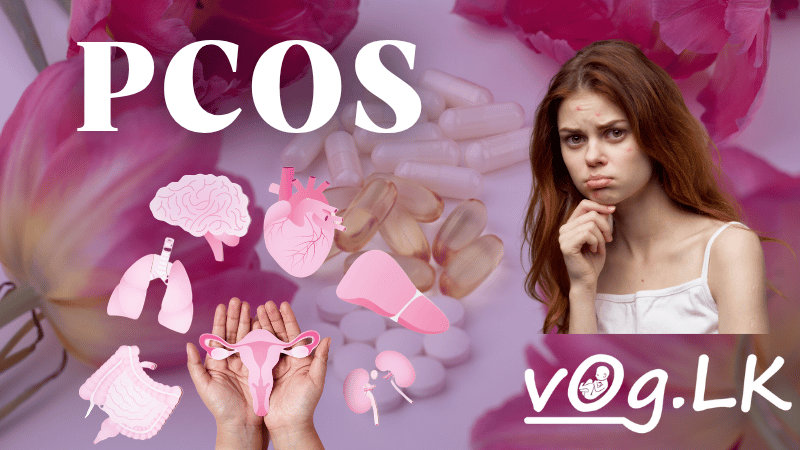 ඩිම්බ කෝෂවල ගෙඩි නොවන PCOS රෝග තත්වය ගැන දැන ගන්න
