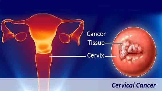 ගැබ් ගෙල පිළිකාව (cervical cancer)