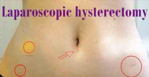 laparoscopic hysterectomy