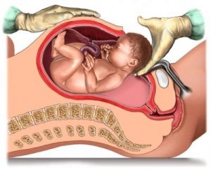c-section vog lk