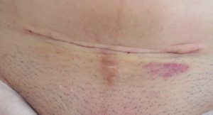 caesarean section VOG LK