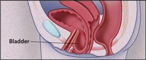 cystocele_pf_500
