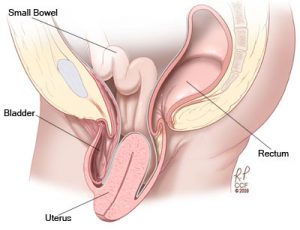 uterine-prolapse