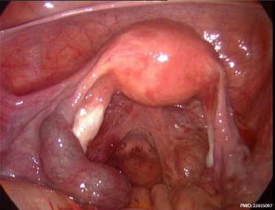 ectopic pregnancy