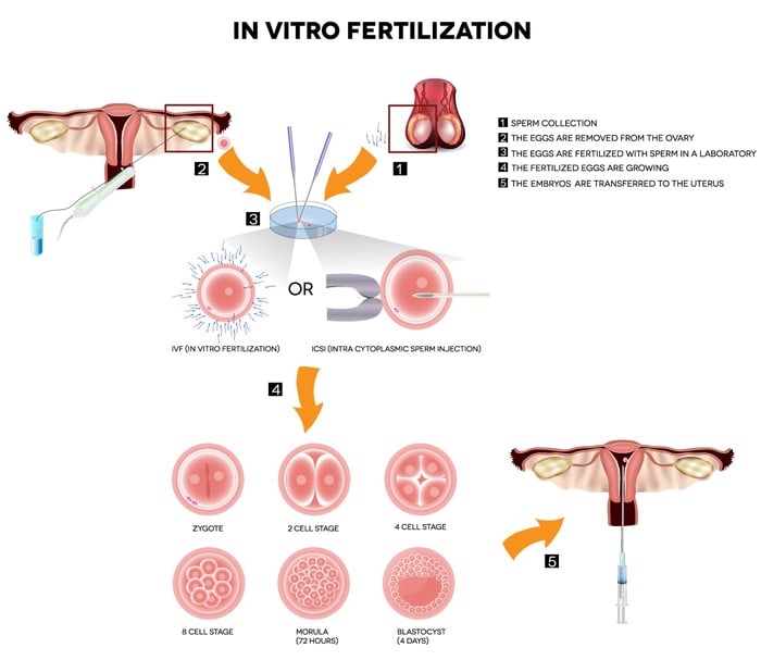 ivf-fig