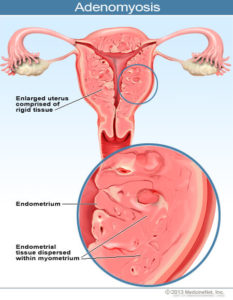 2013-illustration-adenomyosis