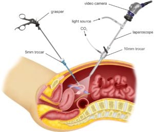 laparoscopic hysterectomy