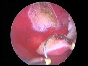 hysteroscopy fibroids