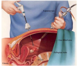 laparoscopic myomectomy