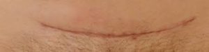 myomectomy open