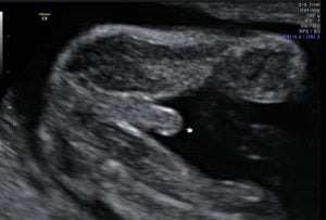 baby gender scan