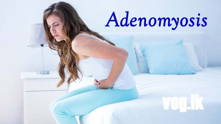 ගර්භාෂය ඉදිමෙන ඇඩිනොමයෝසිස් රෝග තත්වය. Adenomyosis
