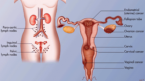 නාරි වේද පිළිකා (Gynaecological Cancers)