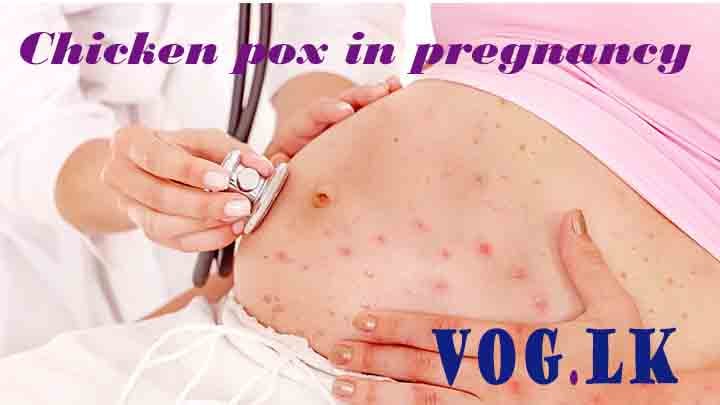 ගර්භණී මවකට පැපොල රෝගය වැලඳුන හොත් (Chickenpox in pregnancy)