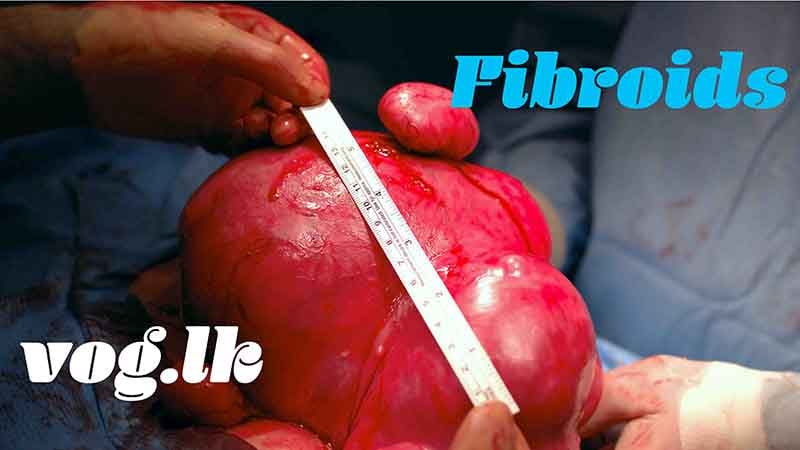 Fibroids ෆයිබ්‍රොයිඩ් ගෙඩි