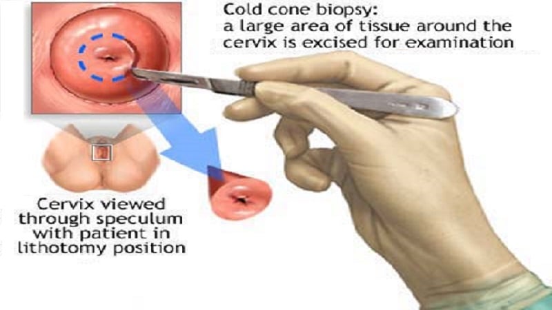 පැප් පරීක්ෂණය (Pap Smear) යනු කුමක් ද?