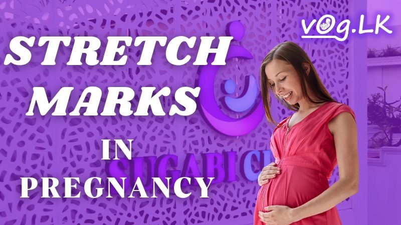 ගර්භණී සමයේ උදරයේ ඉරිතැලීම් ඇති වෙලාද? Stretch marks in Pregnancy