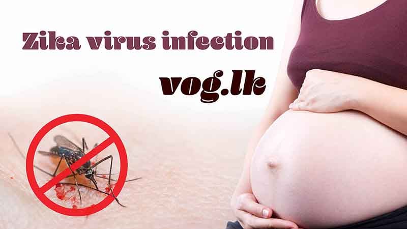 ඩෙංගු වගේ මදුරුවන්ගෙන් බෝවෙන සිකා වෛරස රෝගය මවු කුස තුල සිටින දරුවන්ට හානිකරන හැටි.
