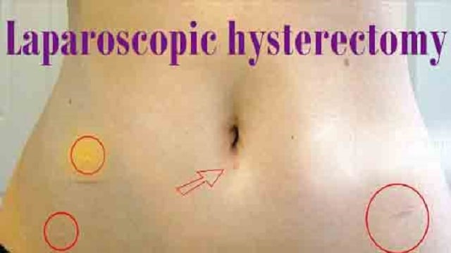Laparoscopic hysterectomy