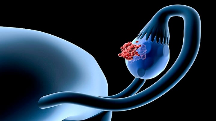 ඩිමබ කෝෂයේ පිළිකා (Ovarian cancer)