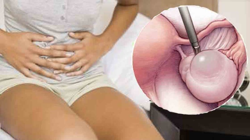 Ovarian cysts (ඩිම්බ කෝෂයේ ඇති වන ගෙඩි)