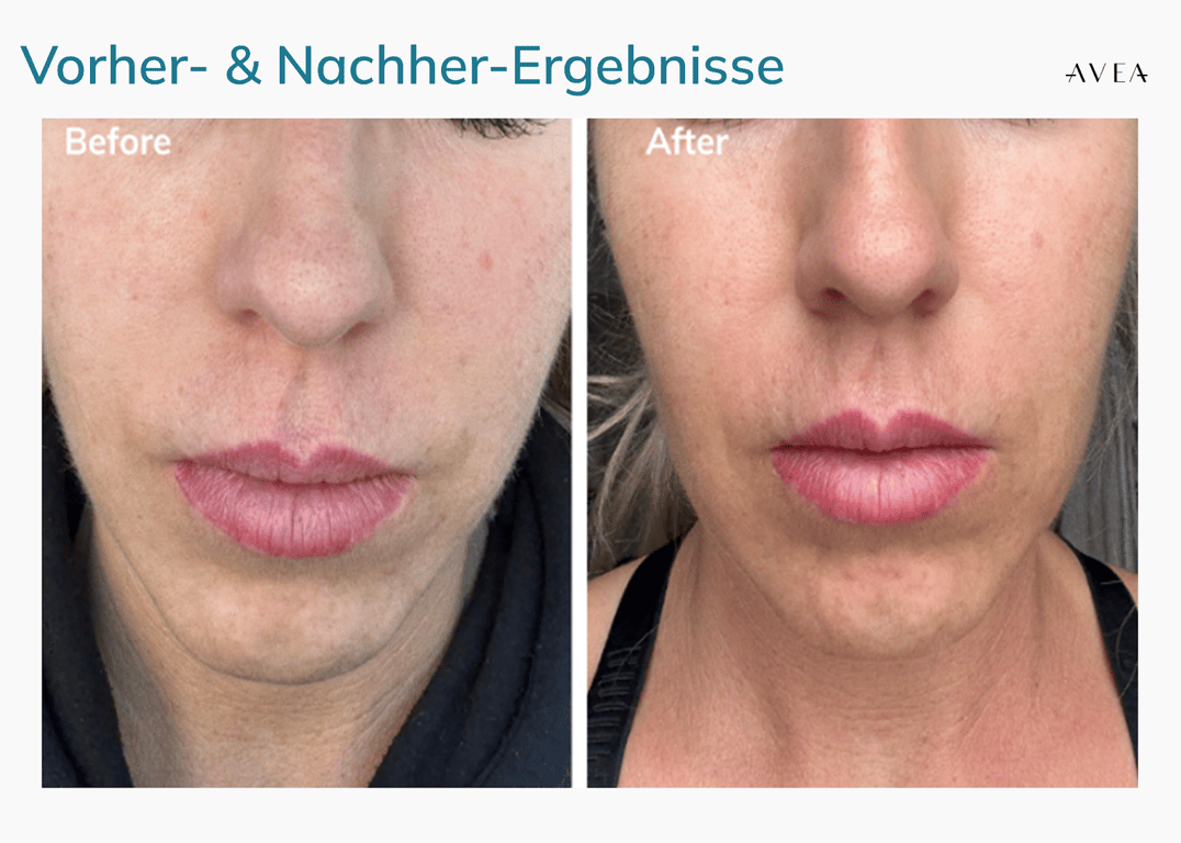 AVEA collagen activator test