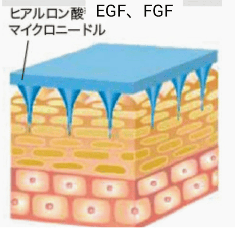 やっぱりニードル！成長因子EGF、FGF、ヒアロルン酸、コラーゲン、プラセンタ補充ニードルパック