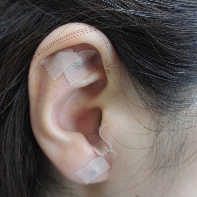 耳つぼシード（王不留行種）100粒入り 5箱セット | 島原 百草の郷