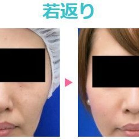 塗るボトックス/ VC22セラム 12ml （リツビ）