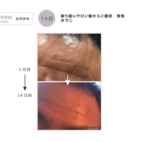 [セインムー・ボーテロンド 30mL]  部分太り®美容液-顔・首のシワ改善/バストケア