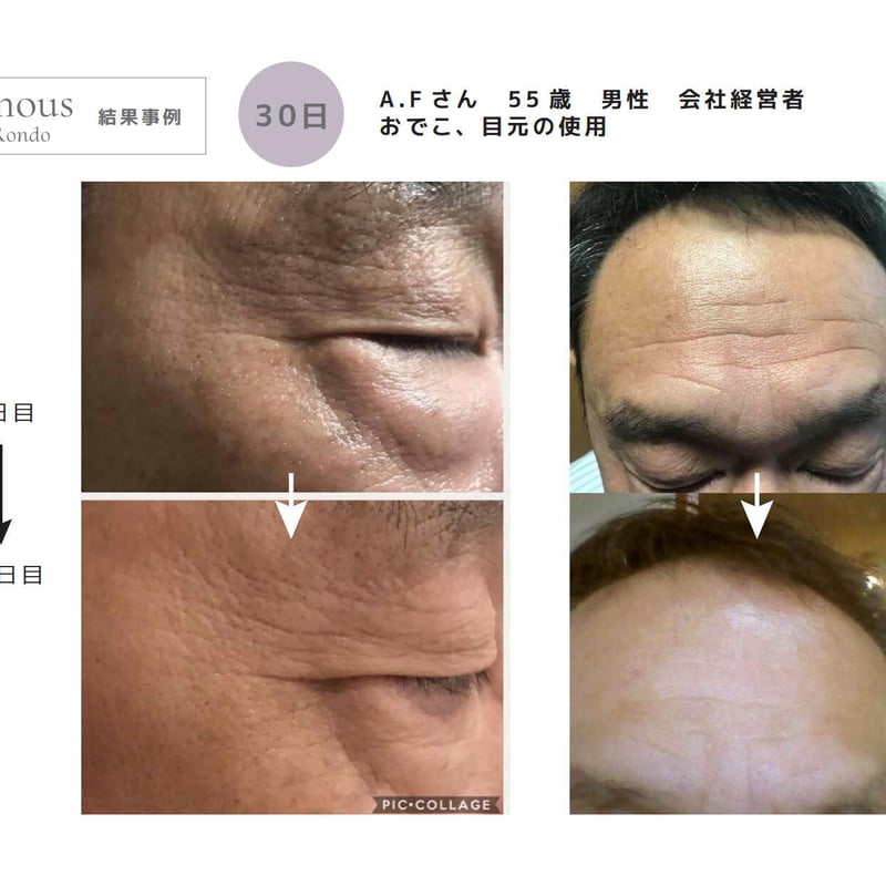 セインムー・ボーテロンド 30mL] 部分太り®美容液-顔・首のシワ