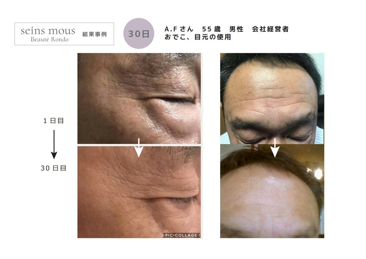 セインムー・ボーテロンド 30mL] 部分太り®美容液-顔・首のシワ改善  