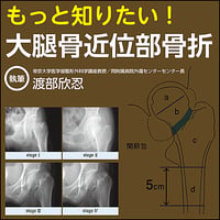 もっと知りたい！大腿骨近位部骨折