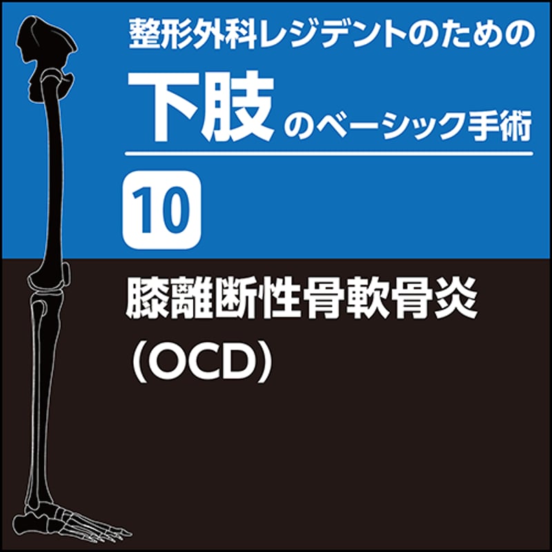 整形外科レジデントのための下肢のベーシック手術10 膝離断性骨 整形外科レジデントのための下肢のベーシック手術10 膝離断性骨